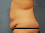 Tummy Tuck (Abdominoplasty)