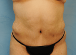 Tummy Tuck (Abdominoplasty)