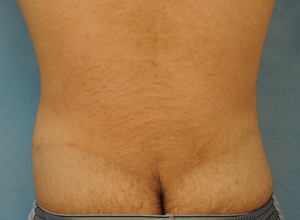 Circumferential Body Lift