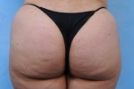 Brazilian Butt Lift