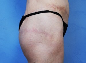 Pursestring Butt Lift (Gluteoplasty)