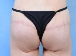 Pursestring Butt Lift (Gluteoplasty)