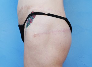 Pursestring Butt Lift (Gluteoplasty)