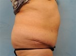 Panniculectomy