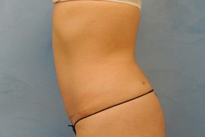 Tummy Tuck (Abdominoplasty)