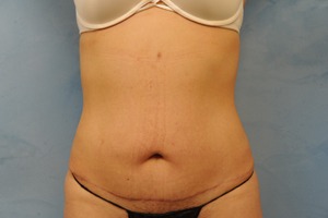 Tummy Tuck (Abdominoplasty)