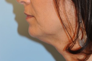 Kybella