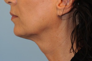 Kybella