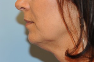 Kybella