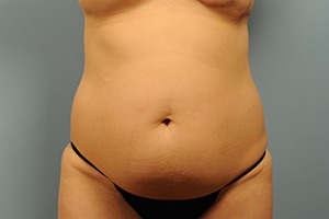 Breast Reconstruction