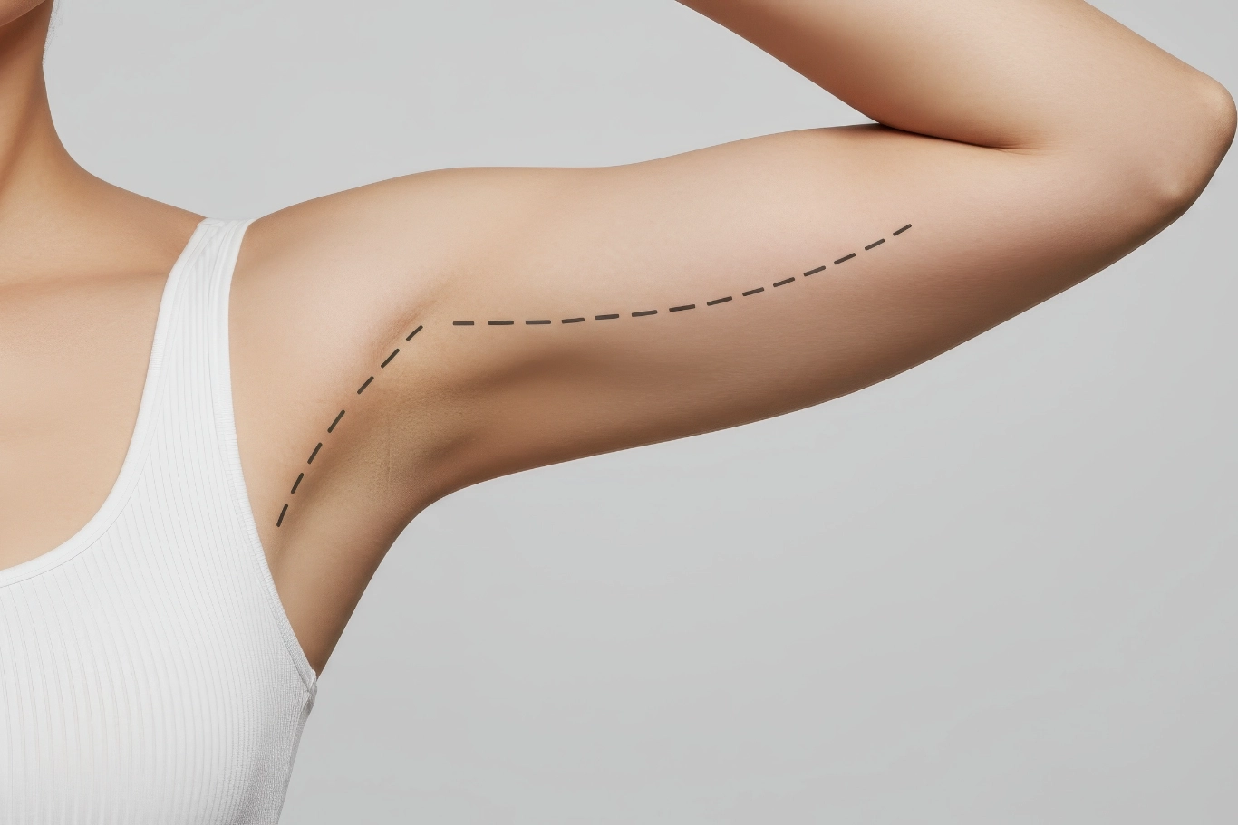 arm lift procedure highlighting sculpted arms female arm with dashed lines for cosmetic surgery concept